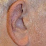 ear-reconstruction-after