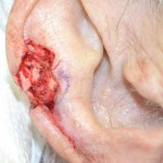 ear-reconstruction-before