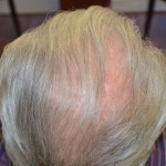 scalp-repair-after