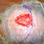 scalp-repair-before