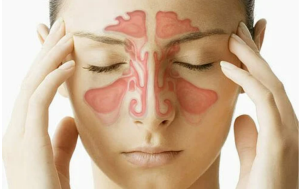 sinusitis