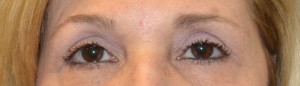 upper-blepharoplasty-eye-2-after